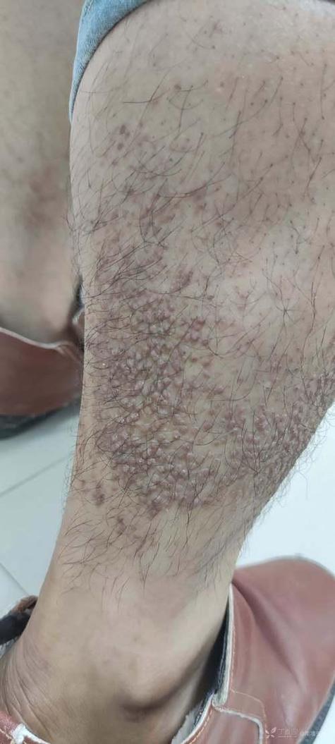 原发性皮肤淀粉样变性如何有效治疗?