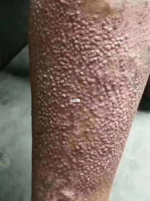 原发性皮肤淀粉样变性如何有效治疗?