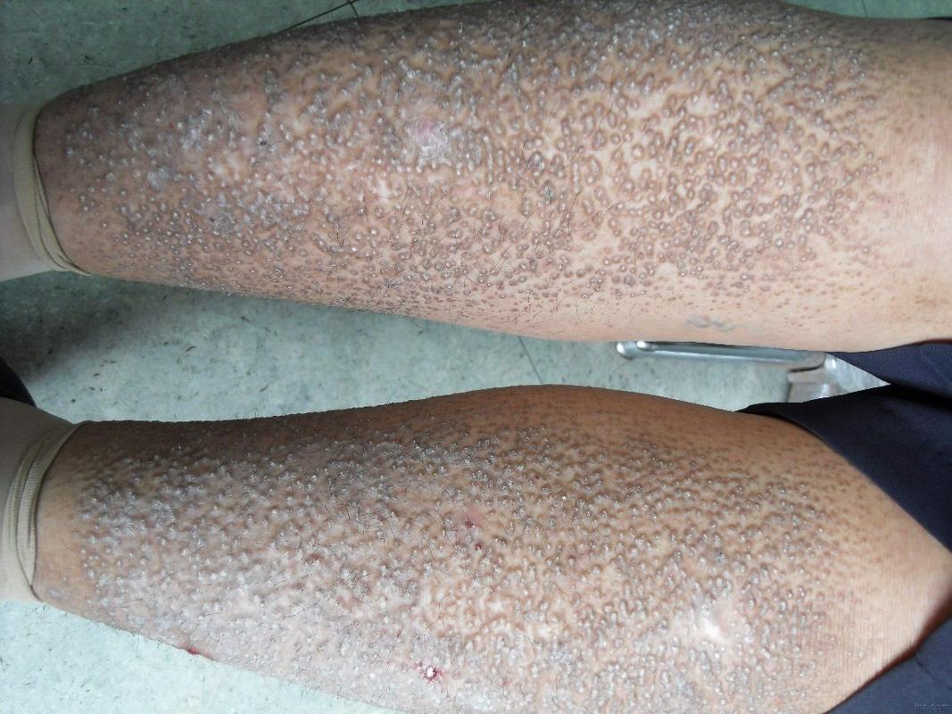 原发性皮肤淀粉样变性如何有效治疗?