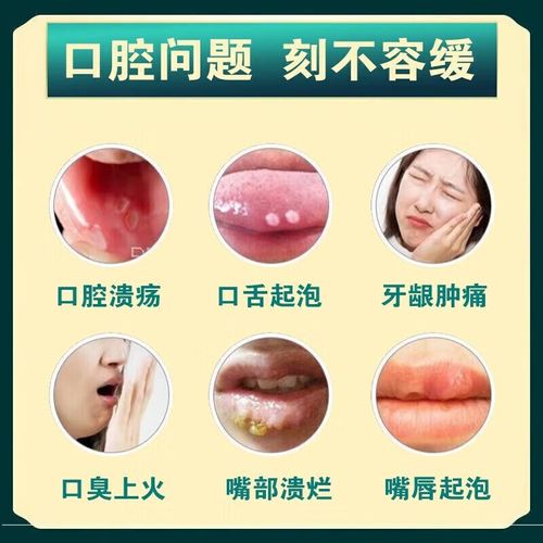 小孩口腔疱疹吃什么药最有效?