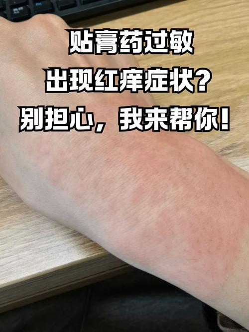 皮肤过敏红肿瘙痒图片怎么办?