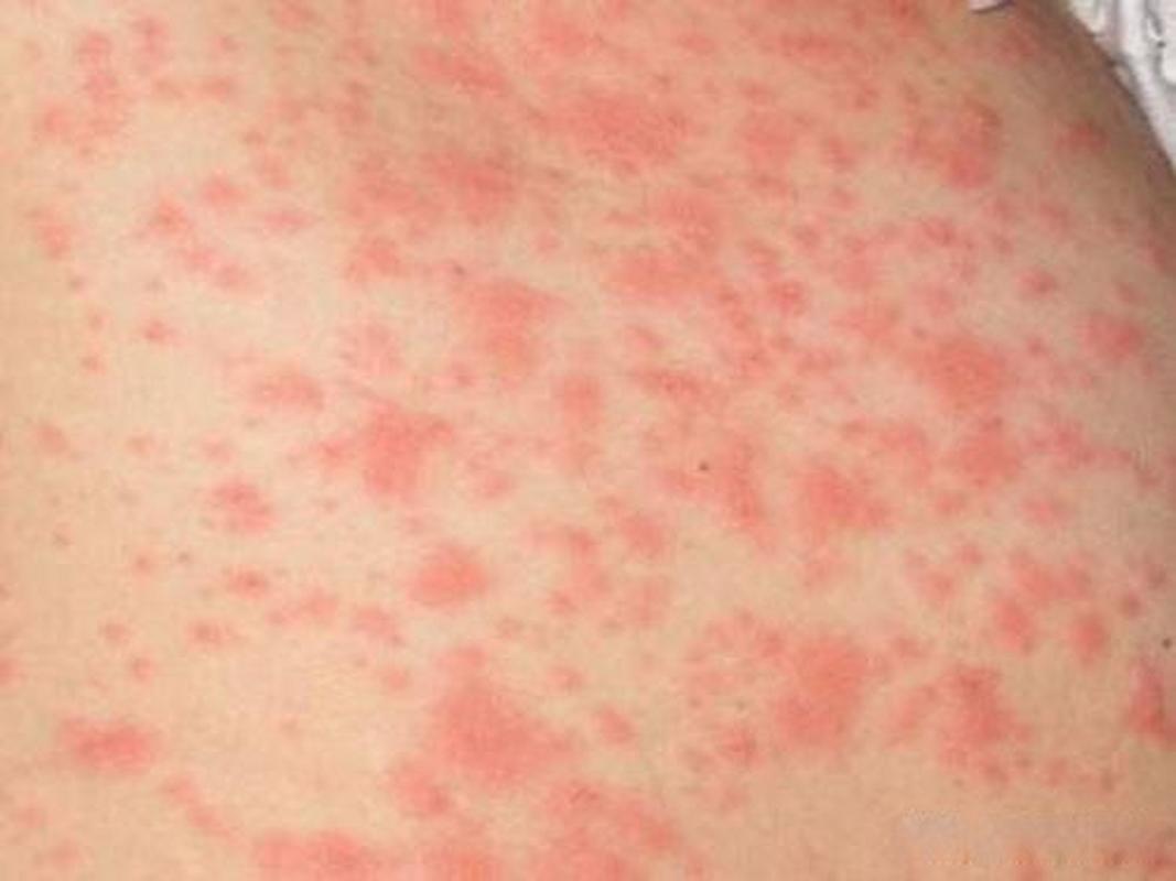 皮肤过敏红肿瘙痒图片怎么办?