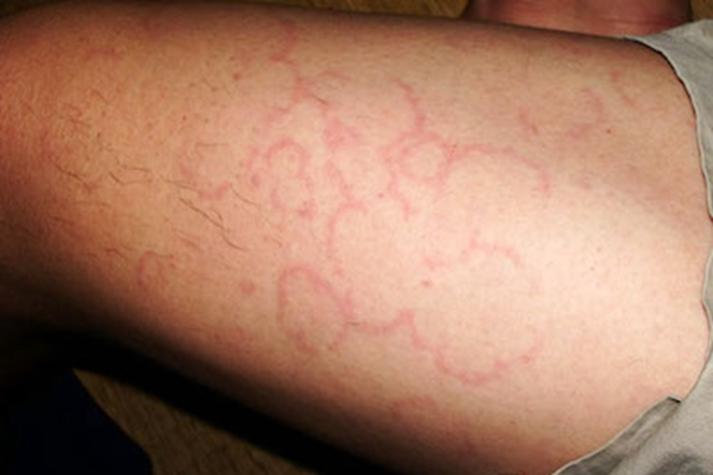 风湿病会引发皮肤瘙痒吗?