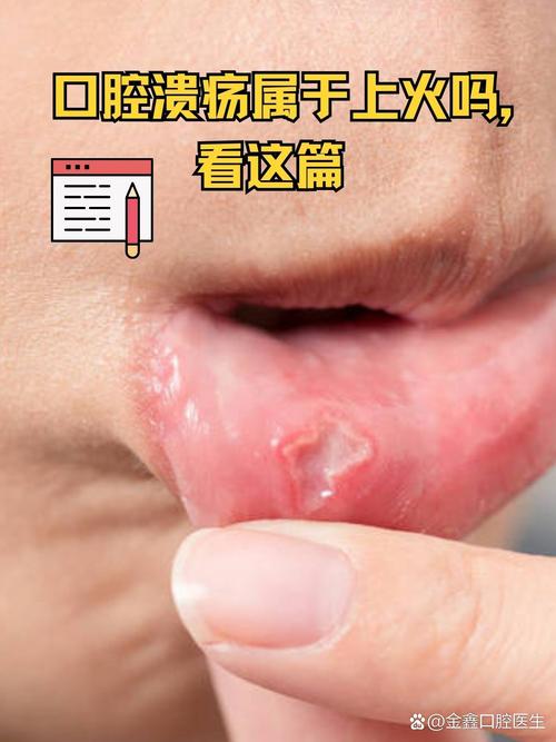 口腔反复溃疡长泡是何原因?