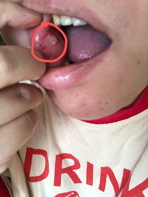 口腔反复溃疡长泡是何原因?