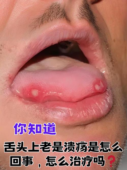 口腔反复溃疡长泡是何原因?