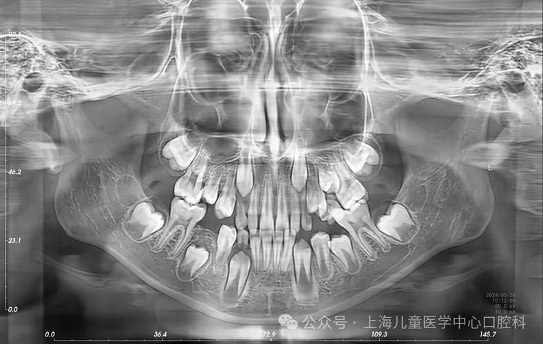 全景口腔片辐射危害有多大?