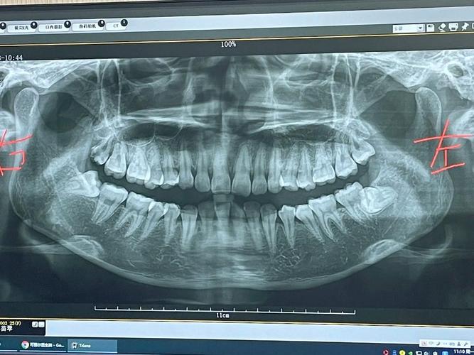 全景口腔片辐射危害有多大?