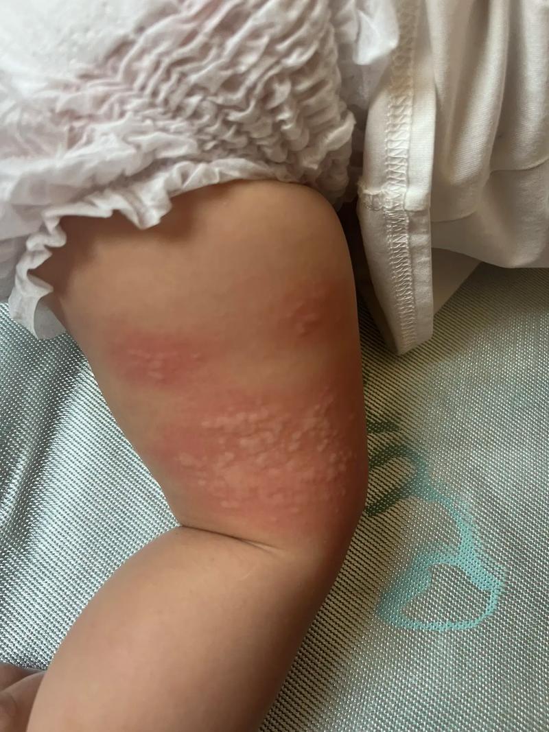 小孩皮肤过敏图片大全能直接判断过敏原因吗?