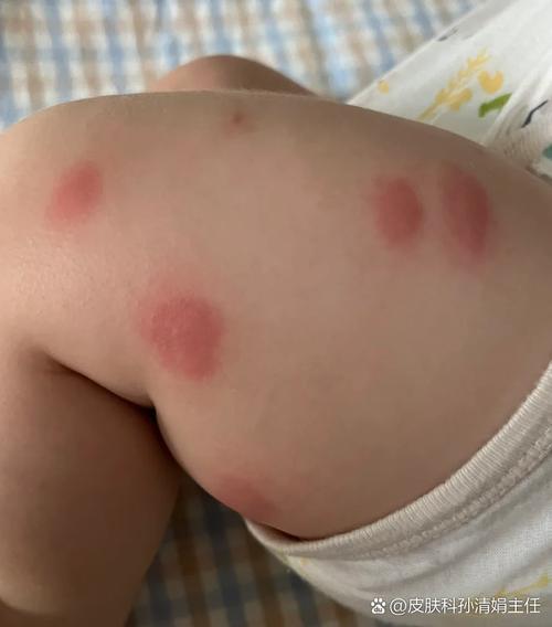 小孩皮肤过敏图片大全能直接判断过敏原因吗?