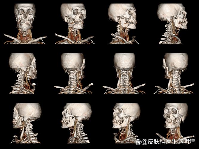 皮肤CT能查哪些皮肤病?