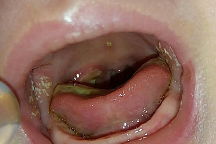 婴儿口腔白色奶块是鹅口疮还是正常现象?