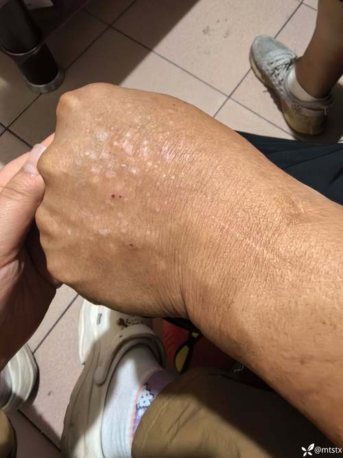 婴儿口腔白色奶块是鹅口疮还是正常现象?