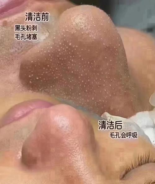 毛孔垃圾怎么清理才有效?
