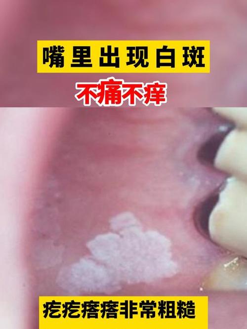 口腔内壁发白是何原因?