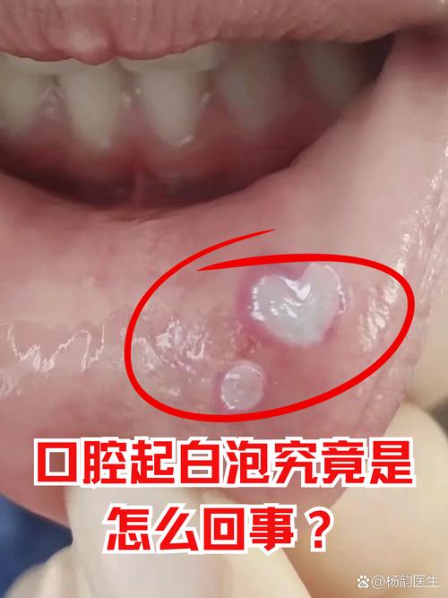 口腔内壁发白是何原因?