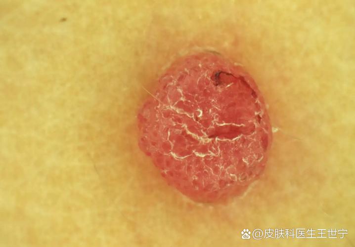 红色一圈是哪种皮肤病?