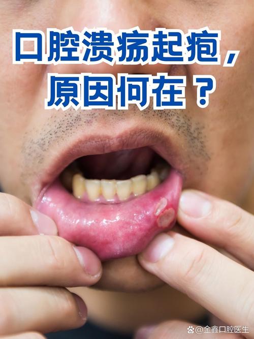 口腔溃疡为何总被自己咬到?