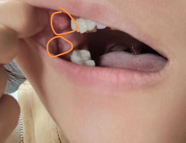 口腔长肉疙瘩是啥病?看图辨原因。