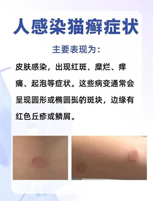 猫皮肤病会传染人吗?