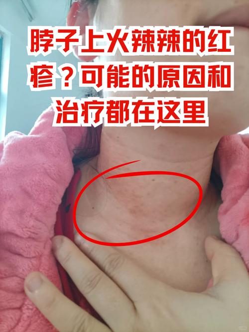 脖子皮肤痒是哪些疾病的信号?