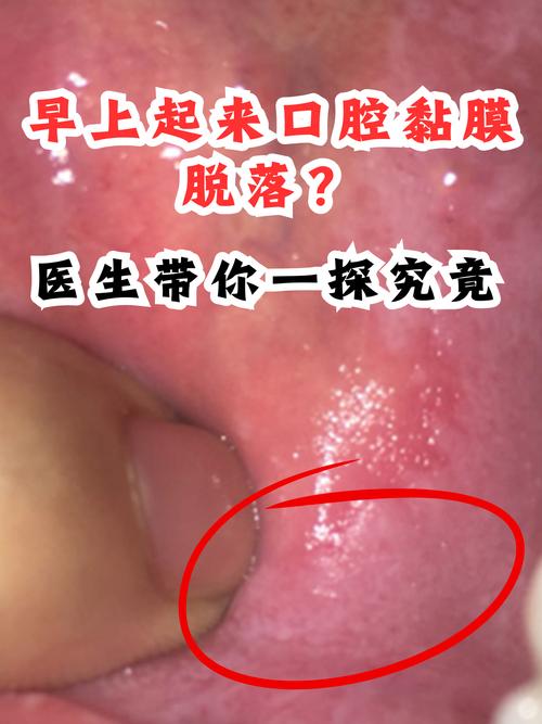 口腔黏膜破损怎么判断?