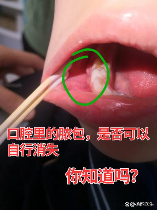 拔牙后口腔感染有哪些症状?