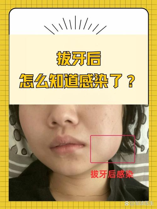 拔牙后口腔感染有哪些症状?