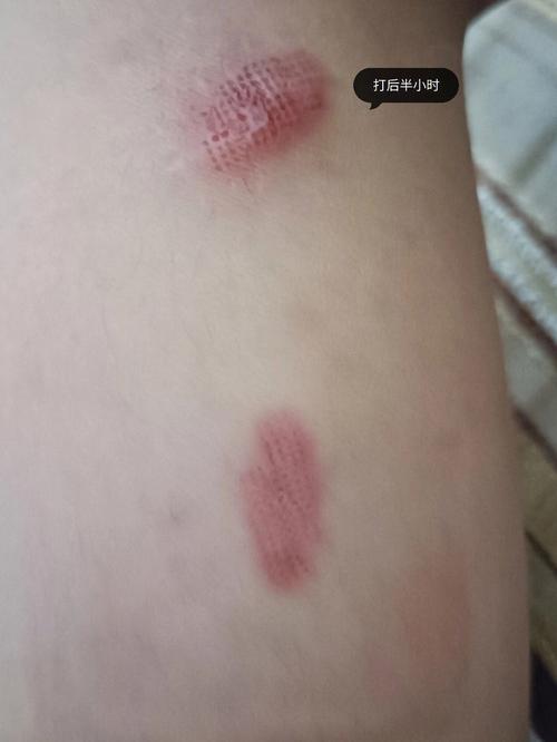 激光灼伤皮肤后该如何紧急处理?