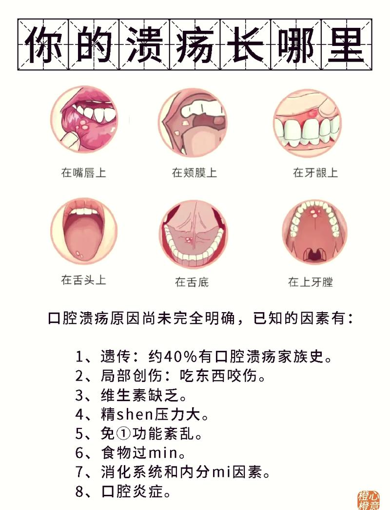 口腔溃疡最快治好方法是什么?