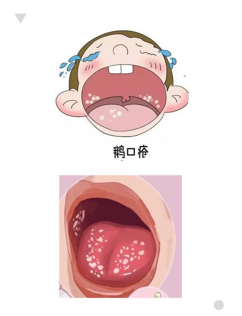 婴儿口腔白色颗粒是何物?
