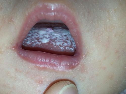 婴儿口腔白色颗粒是何物?