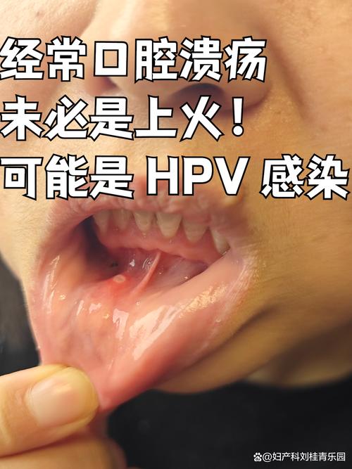 口腔人乳头瘤病毒图片长啥样?