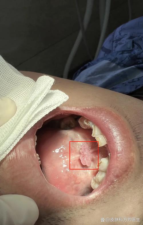 口腔人乳头瘤病毒图片长啥样?