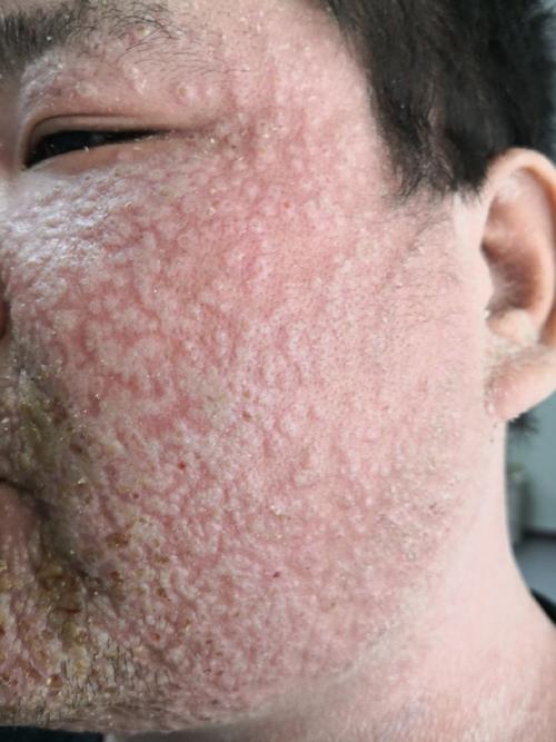 脸部皮肤病种类多,图片如何辨别?