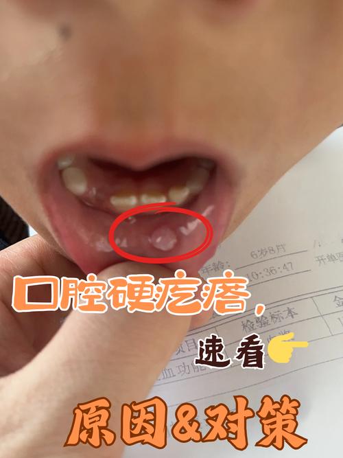 口腔腮腺导管口肉疙瘩是何原因?