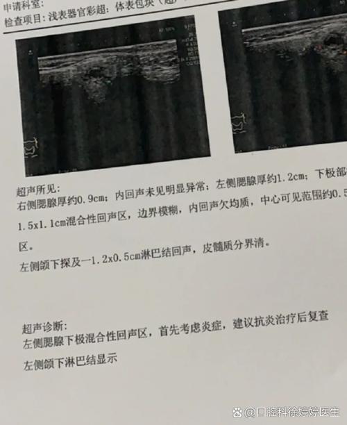 口腔腮腺导管口肉疙瘩是何原因?