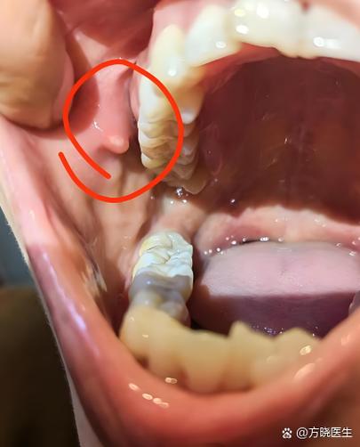 口腔腮腺导管口肉疙瘩是何原因?