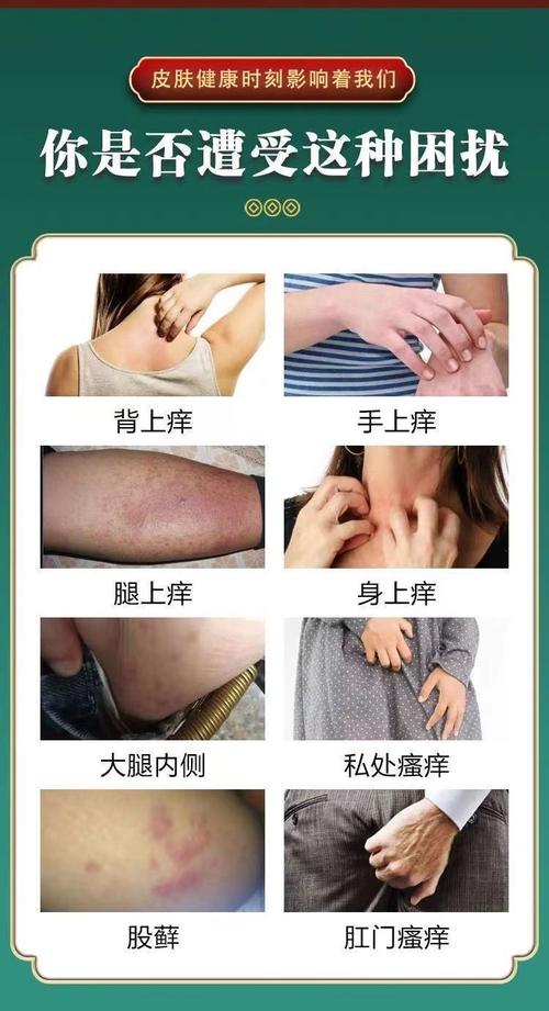 什么东西能快速止痒皮肤?