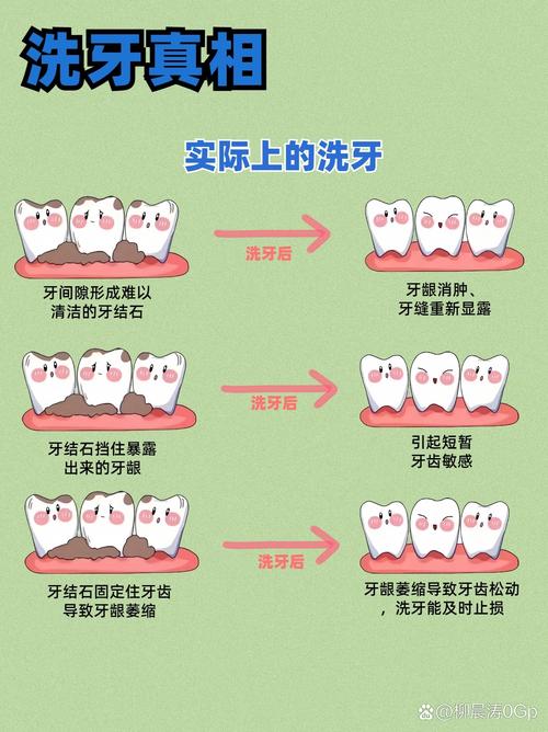 洗牙步骤教学视频,如何正确操作?