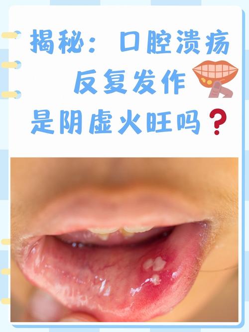 口腔内发热是何原因导致?