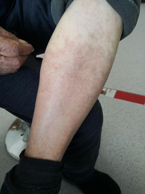 皮肤毛细血管扩张红斑是何因?