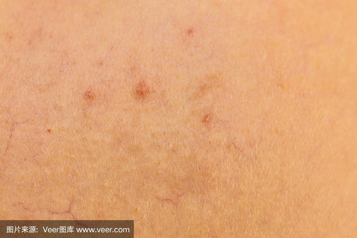 皮肤毛细血管扩张红斑是何因?