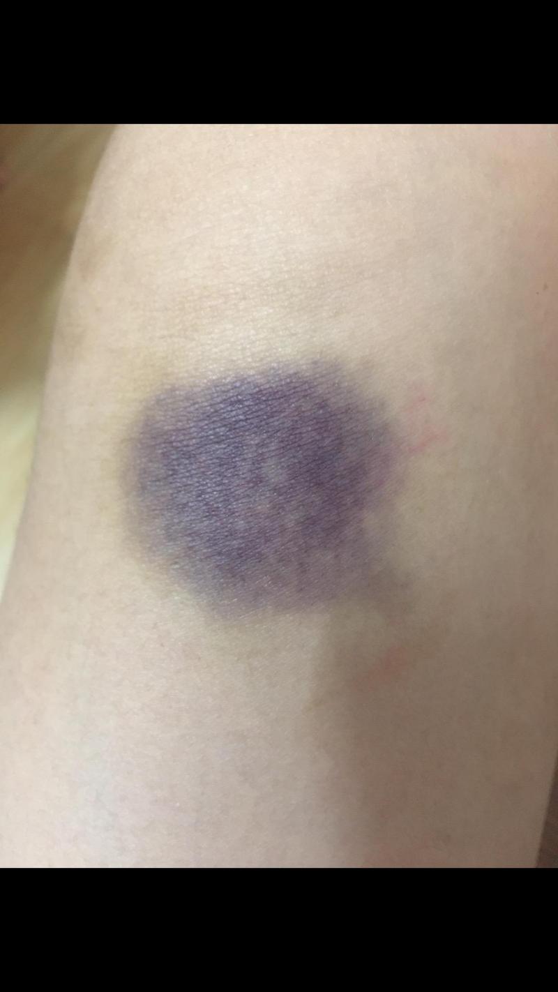 皮肤青紫淤血怎么快速消除?