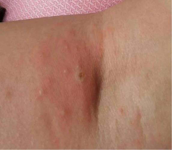 孕妇梦见虫子钻进皮肤是何征兆?