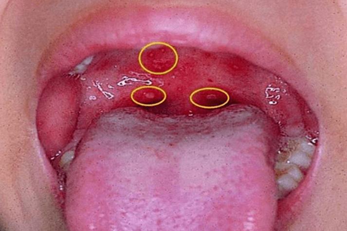 口腔上火有哪些典型症状?