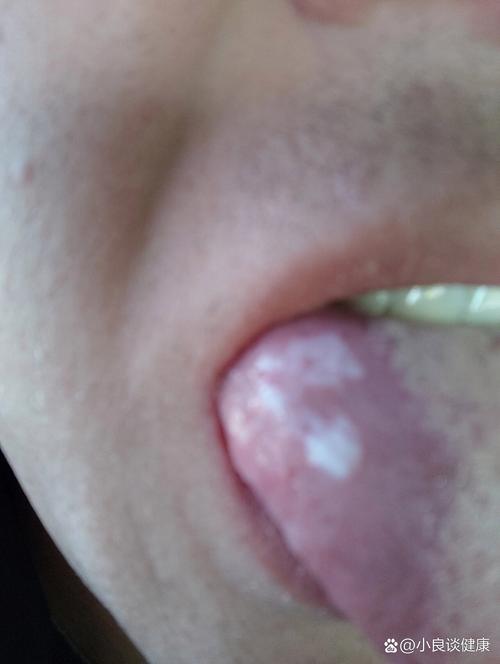 槟榔致口腔发白是癌前病变吗?