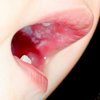 槟榔致口腔发白是癌前病变吗?