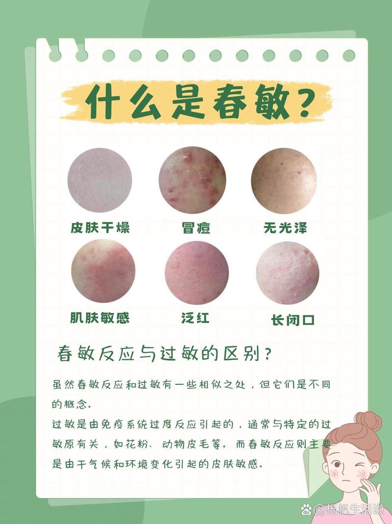 季节性皮肤过敏怎么治?关键在哪儿?