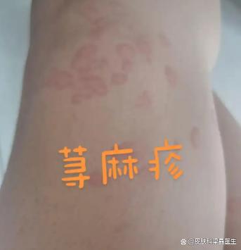 过敏性皮肤病图片大全能自诊吗?